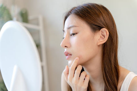 Can Vitamin D Cause Acne?